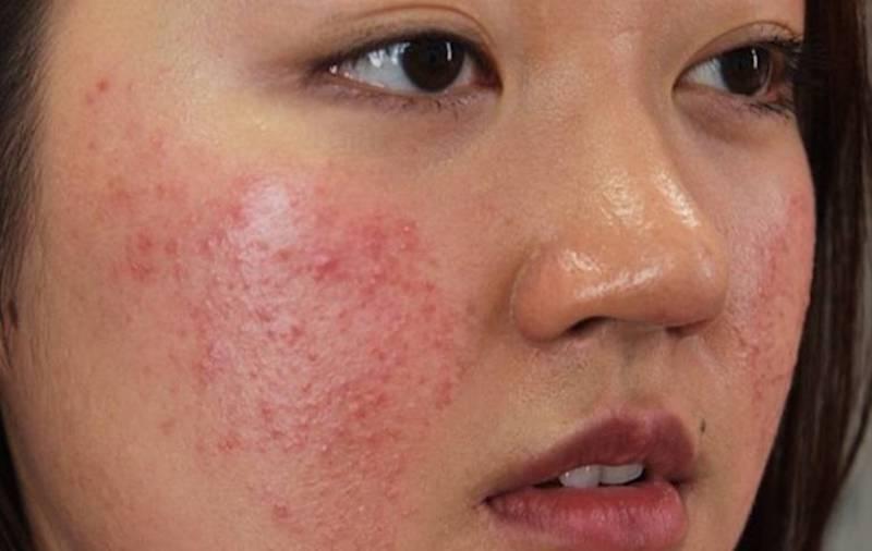 Làm sao chăm sóc da mặt sau khi đi mưa để bảo vệ làn da khỏe mạnh?