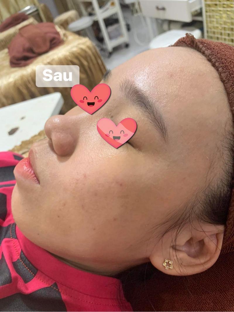 Top 9 Spa trị mụn hiệu quả nhất tại Phú Quốc