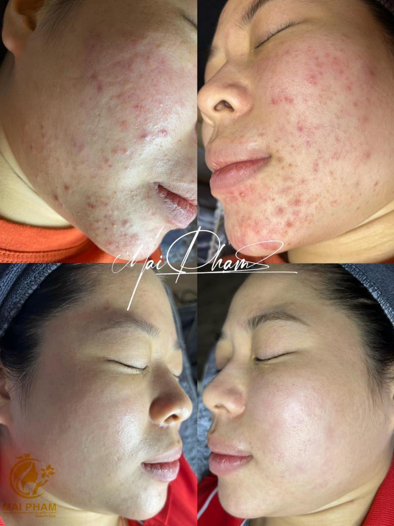 Top 7 Địa Chỉ Trị Mụn Chất Lượng Nhất Bình Dương