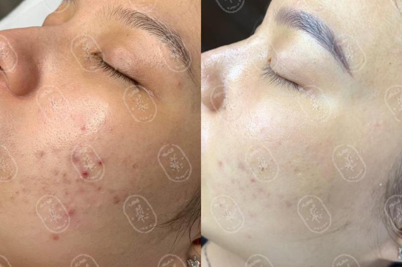 10 Địa chỉ spa trị mụn hàng đầu Đồng Nai – Giải pháp cho làn da sạch mụn, sáng khỏe