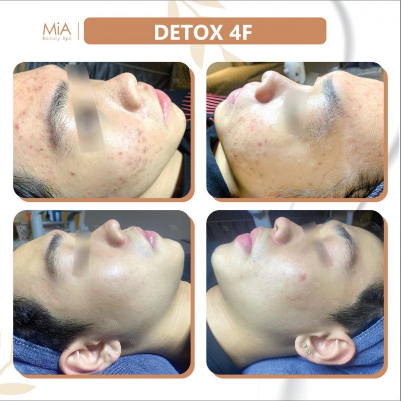 Top 6 Địa chỉ spa trị mụn chất lượng nhất tại Quận 6, TP.HCM