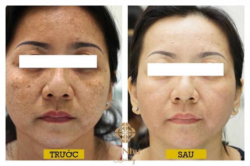 Top 8 Địa Chỉ Spa Trị Nám Chất Lượng Nhất Tại Rạch Giá, Kiên Giang