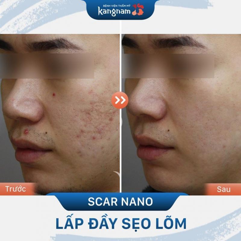 Top 11 Địa chỉ trị sẹo uy tín và hiệu quả hàng đầu tại Hà Nội