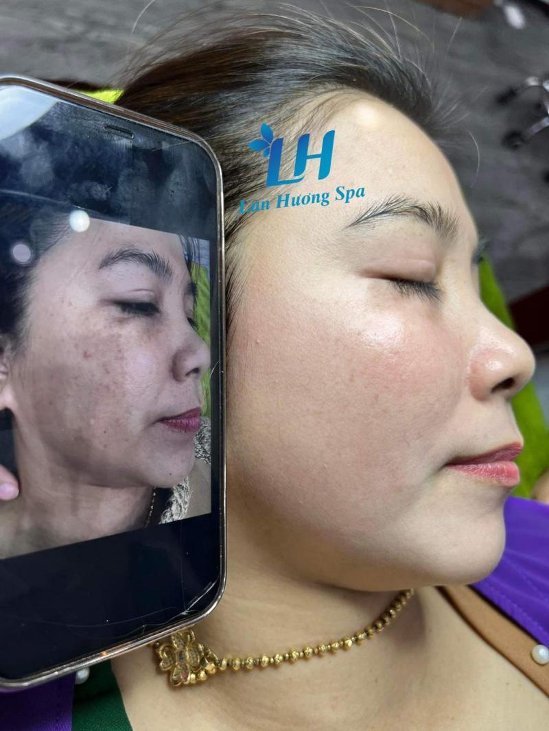 6 Địa Chỉ Spa Trị Nám Uy Tín Nhất Tại TP. Đồng Xoài, Bình Phước