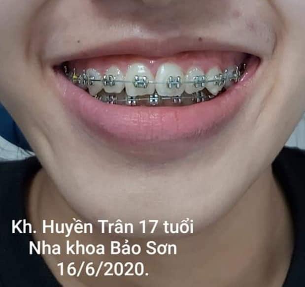 6 Địa chỉ niềng răng đáng tin cậy nhất tại Kon Tum