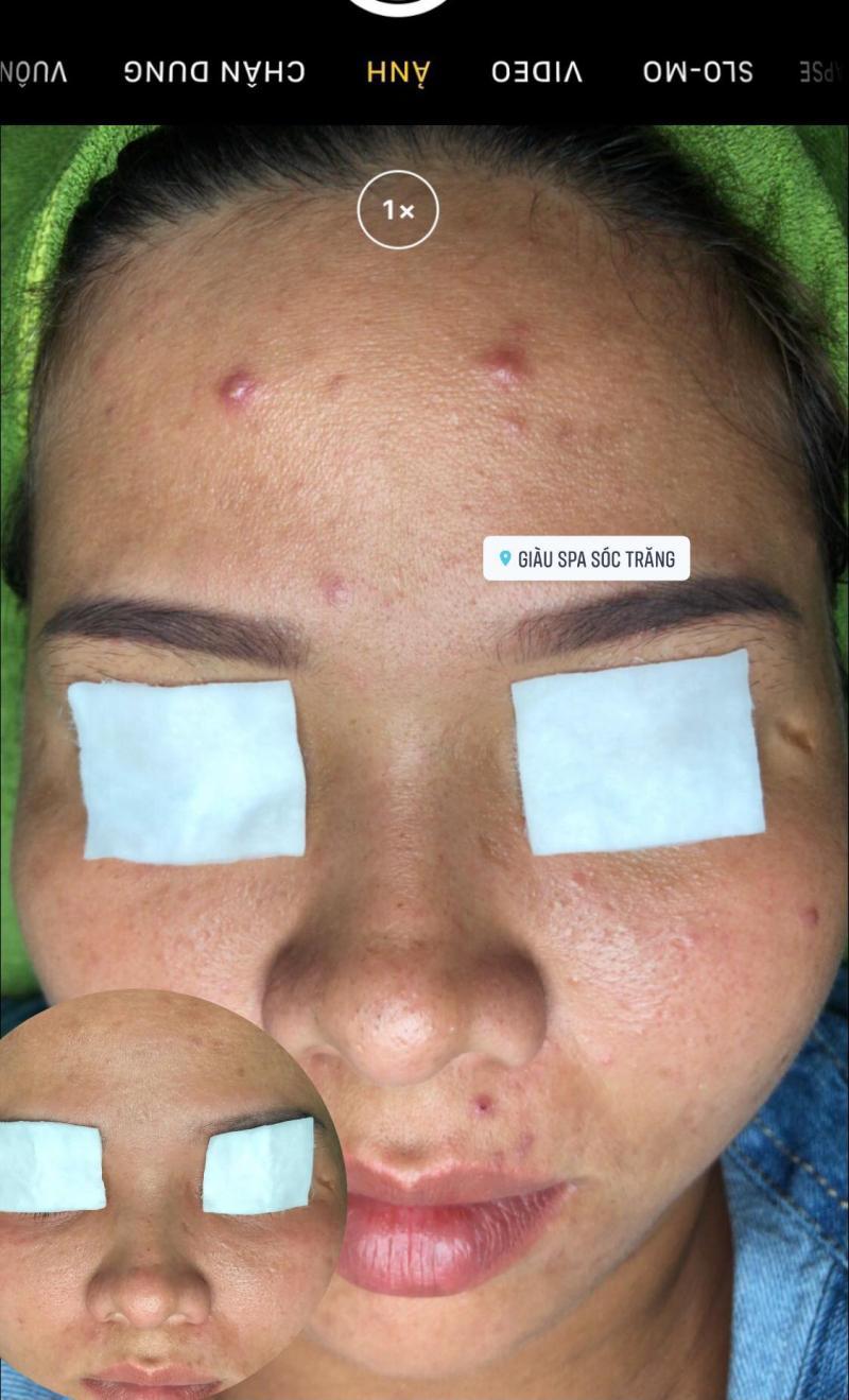 Top 9 Spa trị mụn uy tín, hiệu quả tại Sóc Trăng