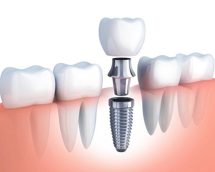 Top 7 Địa chỉ trồng răng implant uy tín và chất lượng nhất tại Lạng Sơn