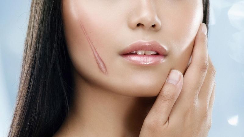 10 Giải Pháp Đánh Bay Sẹo Lồi Hiệu Quả Vượt Trội