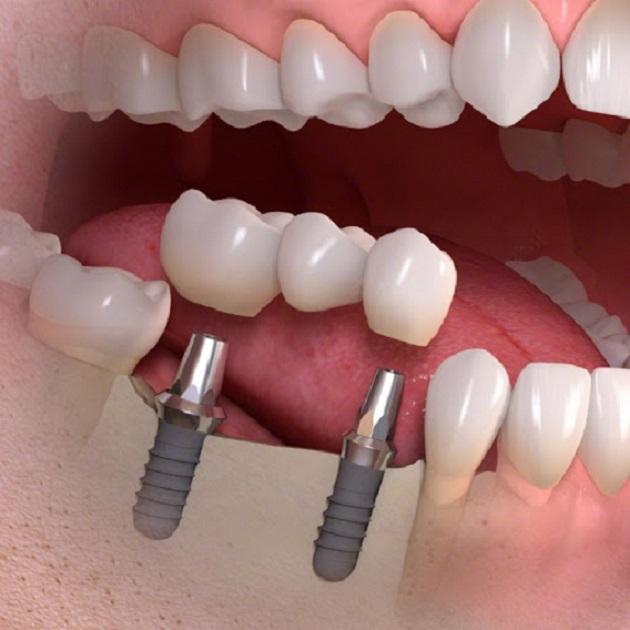 Top 8 phương pháp trồng răng an toàn và hiệu quả nhất hiện nay