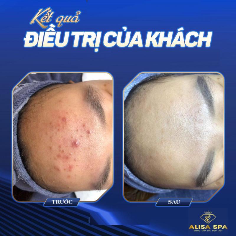 9 Địa chỉ Spa trị mụn uy tín hàng đầu tại Thanh Hóa