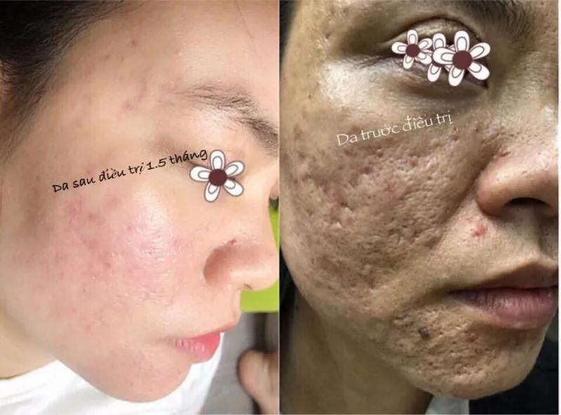 7 Địa Chỉ Spa Trị Sẹo Rỗ Tốt Nhất Đà Lạt – Lựa Chọn Hoàn Hảo Cho Làn Da Mịn Màng