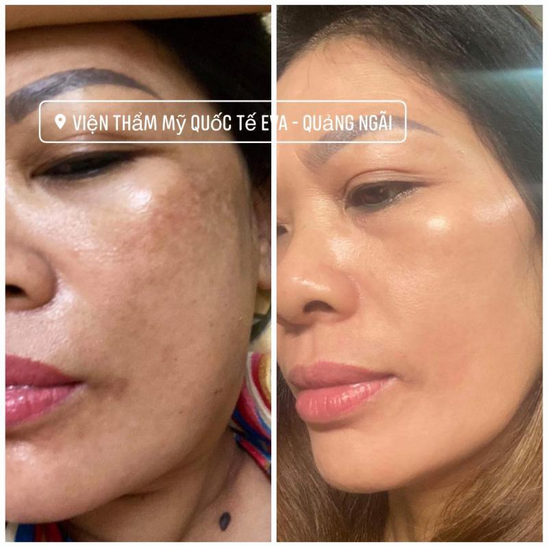 Top 10 Spa điều trị sẹo rỗ uy tín tại Quảng Ngãi
