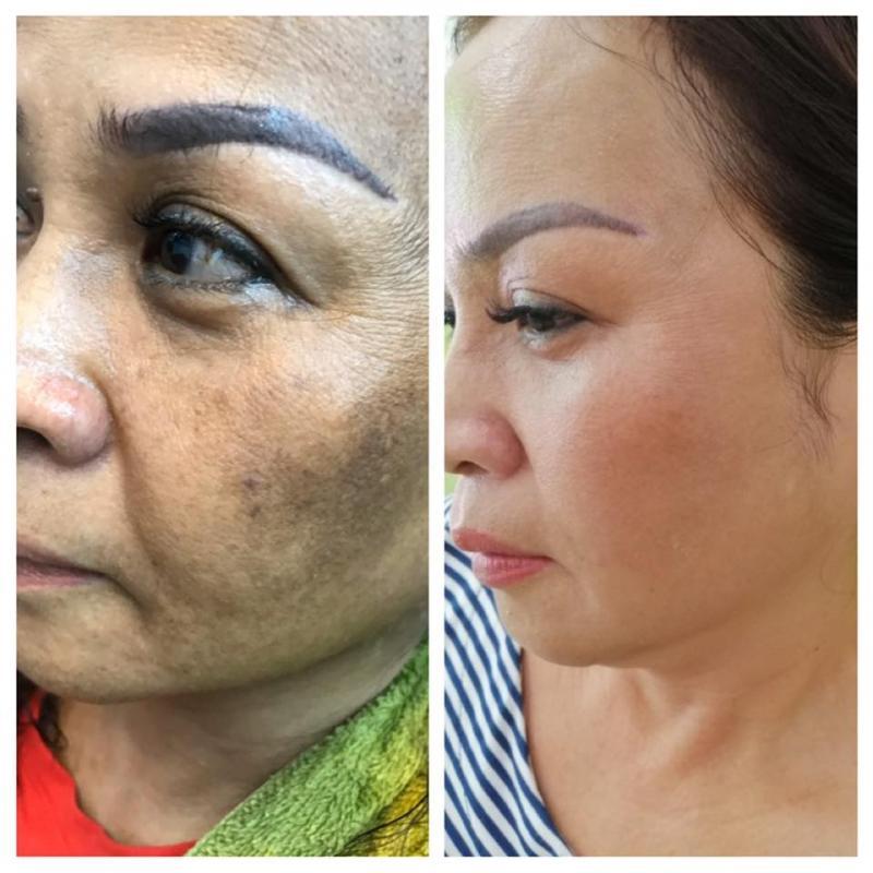 Top 8 spa trị nám hàng đầu tại Quận 11, TP.HCM