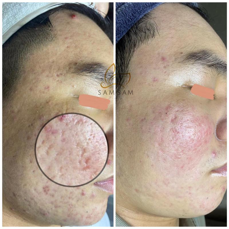 Top 3 địa chỉ trị sẹo rỗ uy tín tại quận Tân Phú, TP. HCM