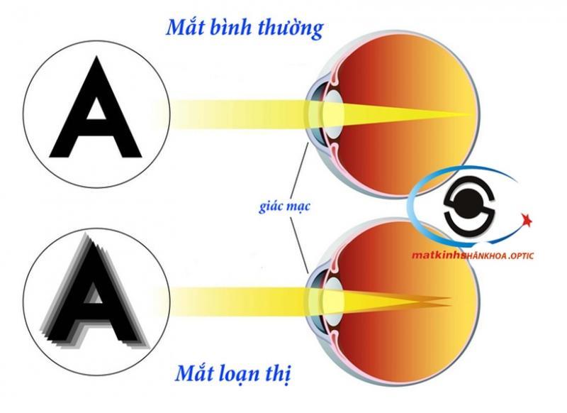 Top 7 bệnh về mắt thường gặp và phương pháp điều trị hiệu quả