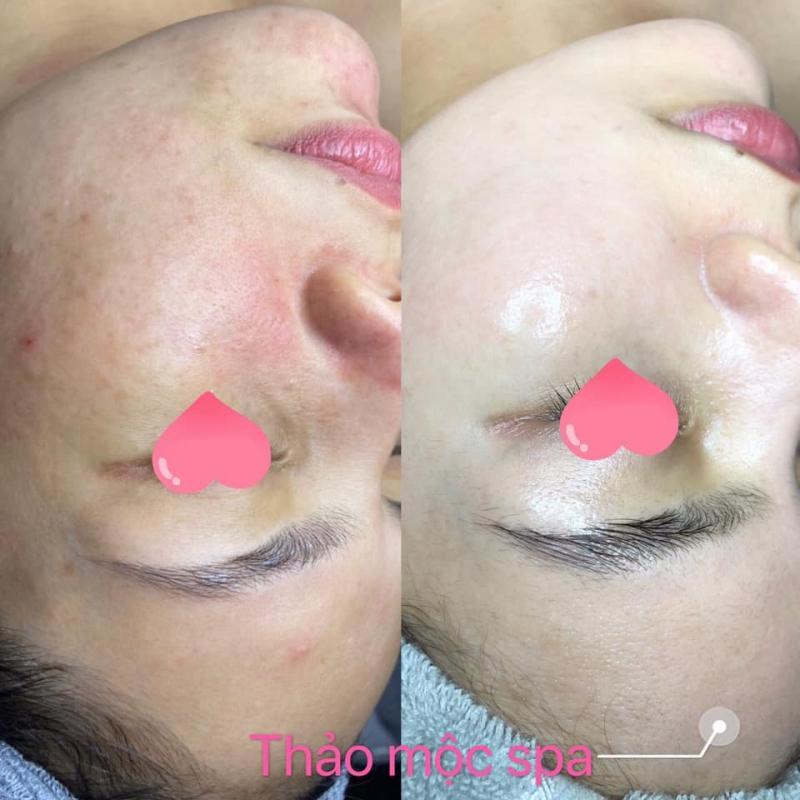 Top 7 Spa trị mụn hàng đầu tại Cà Mau