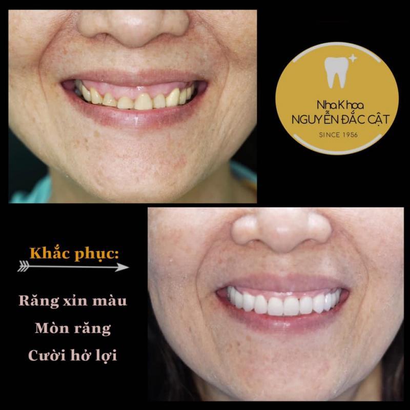 Top 9 địa chỉ tẩy trắng răng đáng tin cậy nhất tại Nha Trang, Khánh Hòa