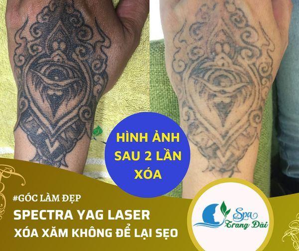 Top 5 Địa Chỉ Xóa Xăm Uy Tín Và Chất Lượng Nhất Tại Bình Dương