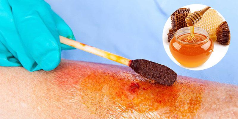 7 Cách Xử Lý Bỏng Tại Nhà Hiệu Quả Nhất Hiện Nay