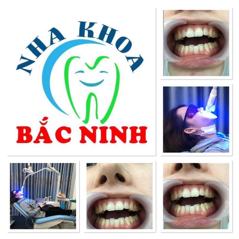 8 Địa điểm bọc răng sứ chất lượng hàng đầu tại Bắc Ninh