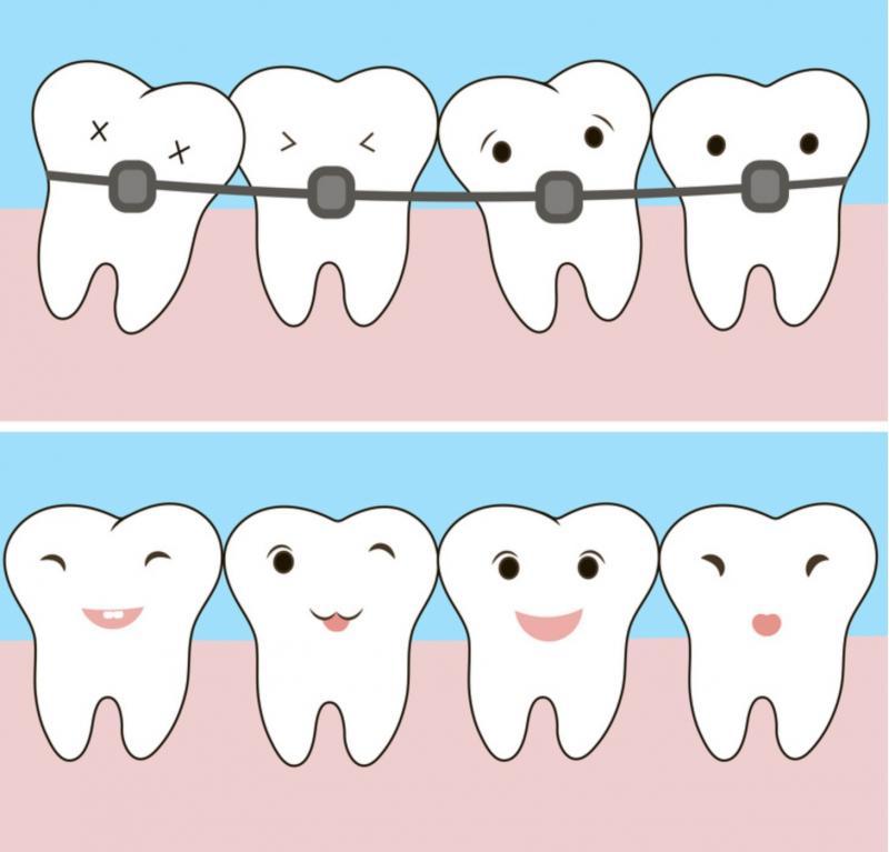 11 Điều quan trọng cần lưu ý trước khi niềng răng