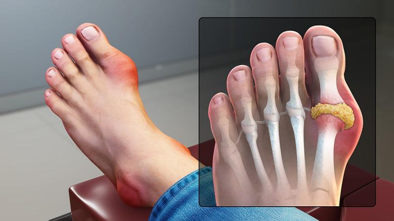 10 Điều quan trọng nhất về bệnh Gout bạn không thể bỏ qua
