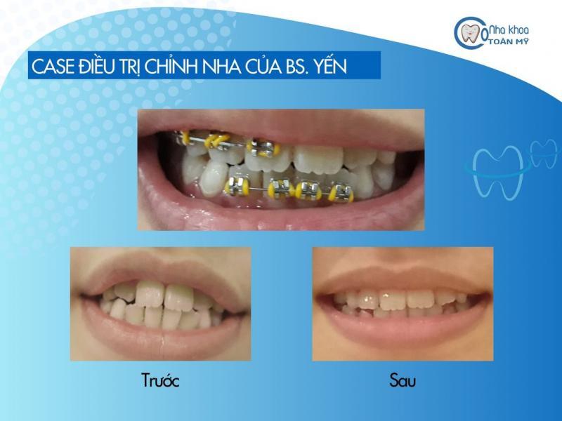 6 Địa Chỉ Niềng Răng Uy Tín Nhất Đồng Tháp Không Thể Bỏ Qua