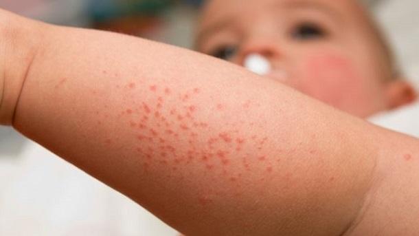 10 bệnh da liễu thường gặp mùa hè và giải pháp phòng ngừa hiệu quả
