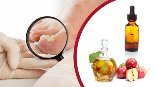 9 Cách Trị Nấm Móng Tay Chân Hiệu Quả Từ Dân Gian Được Tin Dùng