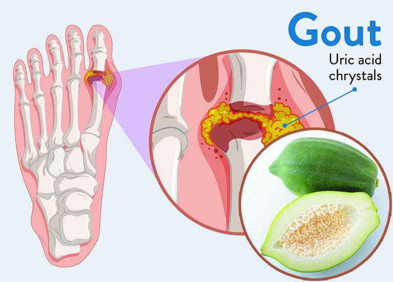 10 Phương Pháp Điều Trị Gút Tự Nhiên Hiệu Quả Nhất
