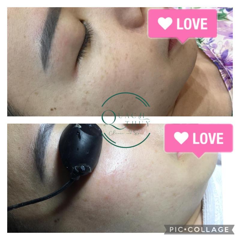 4 Địa Chỉ Spa Trị Nám Đáng Tin Cậy Nhất Tại Quận Thanh Xuân, Hà Nội