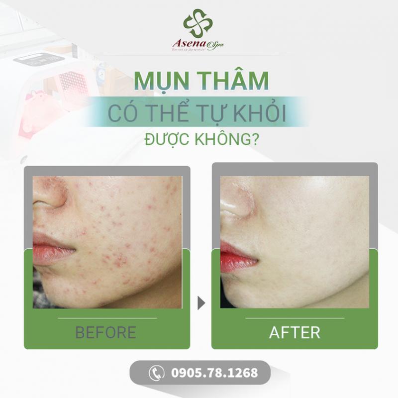 7 Địa chỉ trị thâm chất lượng và đáng tin cậy nhất tại Quảng Bình