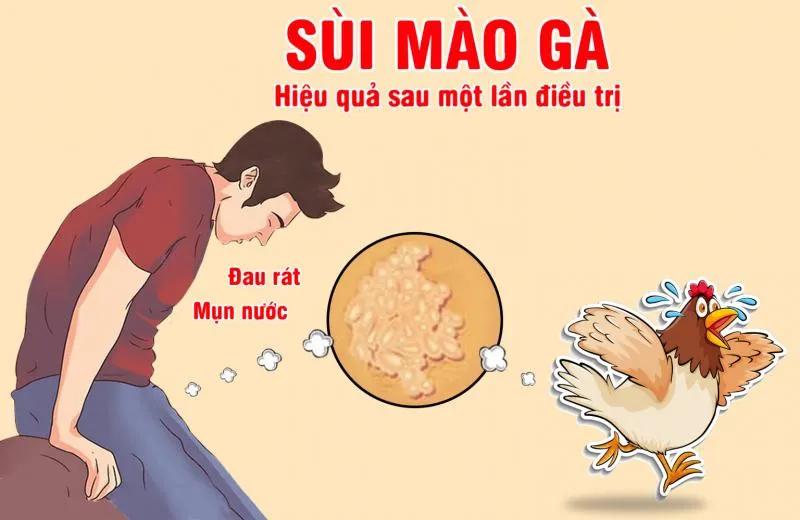 2 địa chỉ Đông y chữa sùi mào gà hiệu quả nhất tại TP.HCM