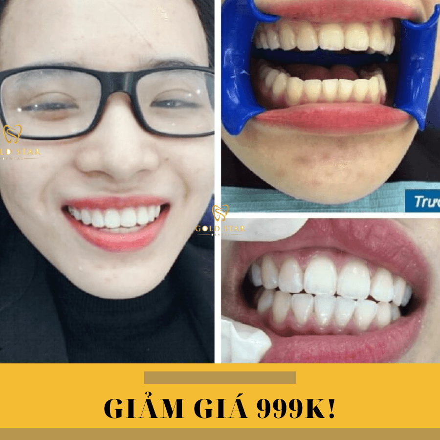 Top 5 địa chỉ tẩy trắng răng đáng tin cậy nhất tại quận Nam Từ Liêm, Hà Nội