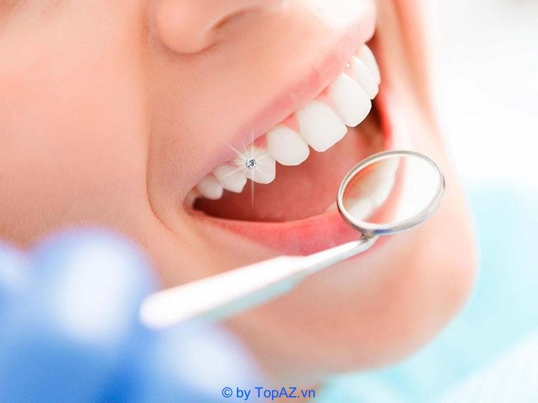 Top 5 địa chỉ đính đá lên răng tại TPHCM đẹp bền – Uy tín hàng đầu