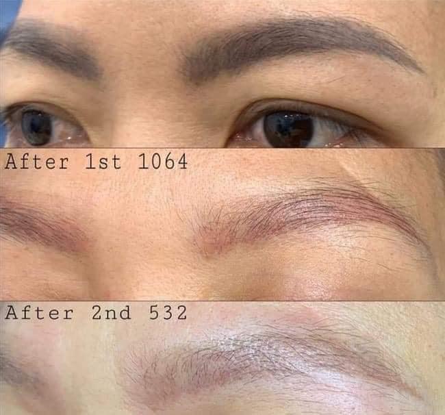 Top 5 địa chỉ xóa xăm lông mày chất lượng và uy tín nhất tại Bình Dương