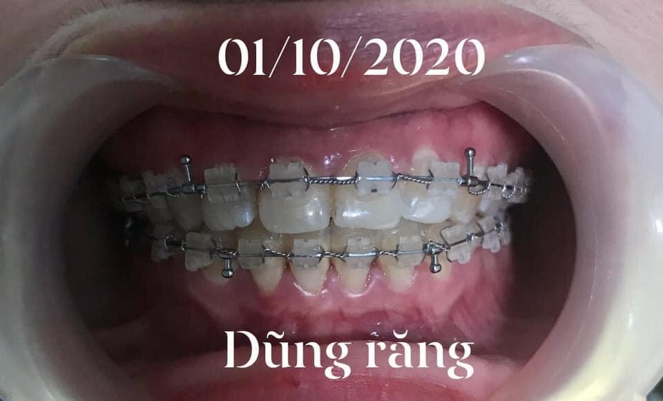 7 địa chỉ niềng răng chất lượng và đáng tin cậy hàng đầu tại Phú Thọ