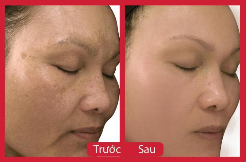 Top 10 địa chỉ Spa trị nám chất lượng nhất tại quận Hoàn Kiếm, Hà Nội