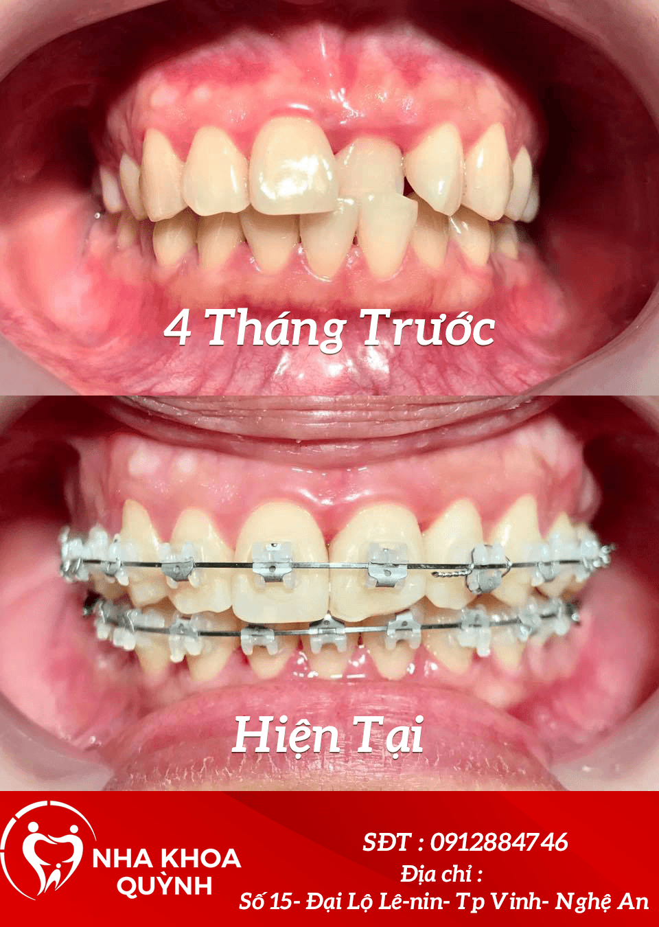 Danh sách 13 địa chỉ niềng răng đáng tin cậy nhất tại thành phố Vinh, Nghệ An