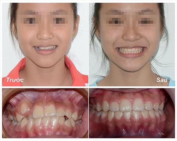 5 Điều quan trọng cần nắm rõ về niềng răng mắc cài kim loại