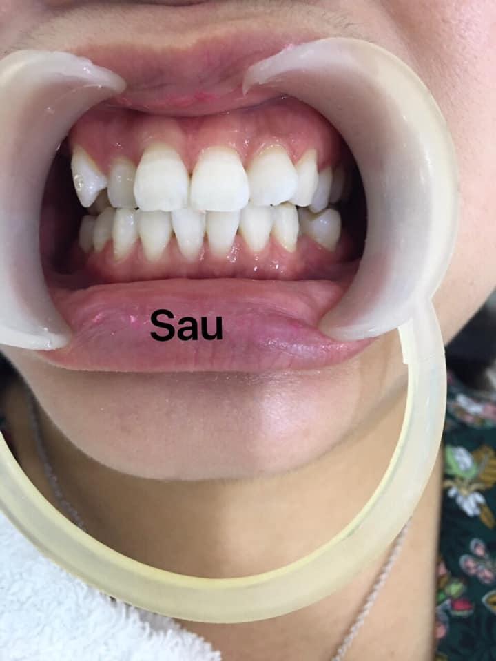 5 Địa chỉ tẩy trắng răng đáng tin cậy nhất tại Bình Tân, TP HCM