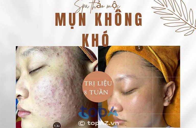 Top 5 địa chỉ spa trị mụn và làm đẹp tại TP. Vị Thanh – chuyên nghiệp, an toàn, mang lại làn da tươi sáng mịn màng