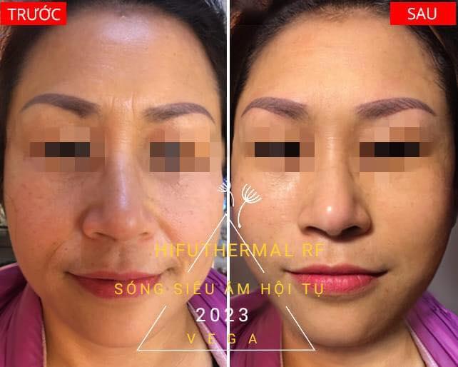 Top 4 địa chỉ Spa làm đẹp chuẩn y khoa và uy tín bậc nhất tại Tp. Bảo Lộc, Lâm Đồng