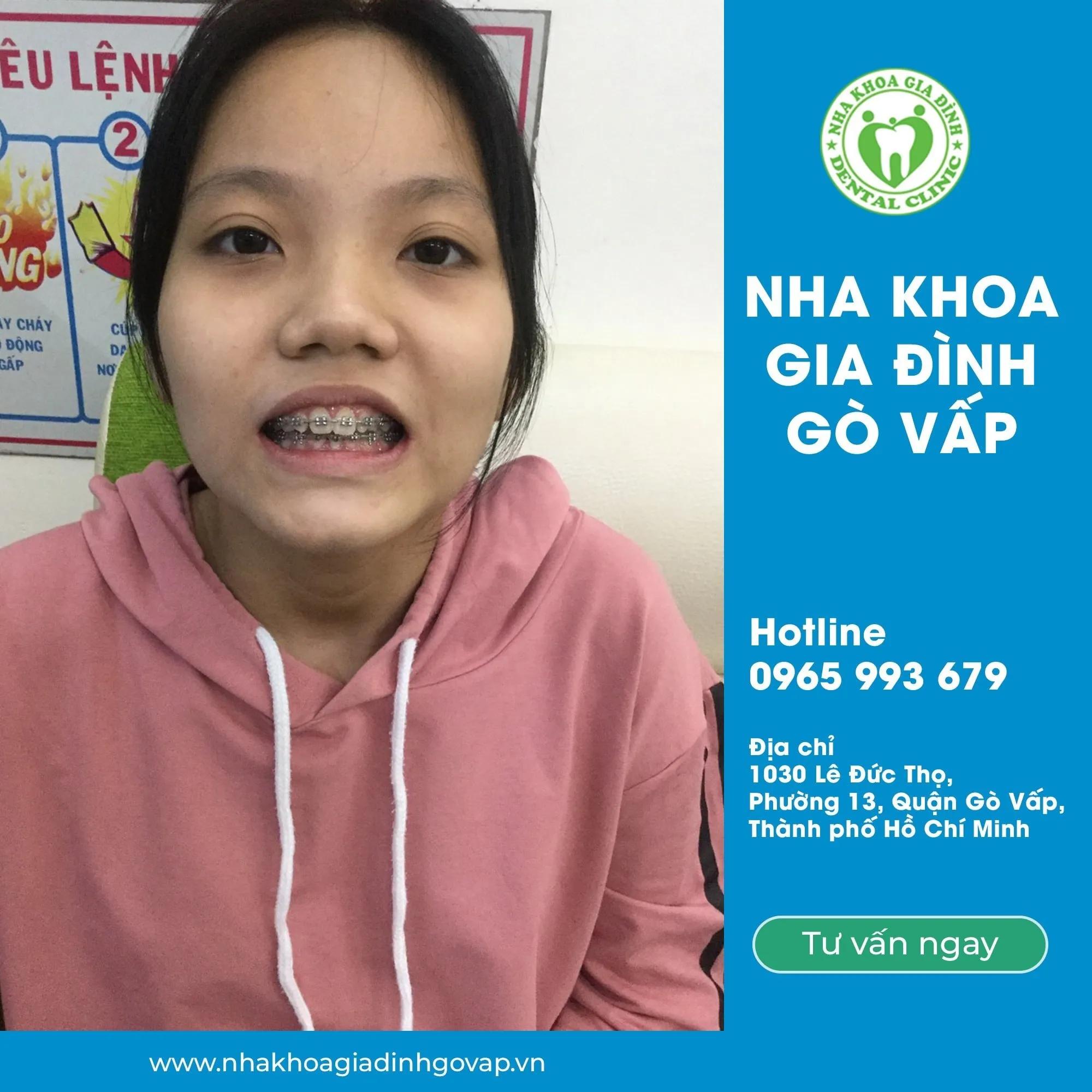 Top 5 địa chỉ niềng răng uy tín và đẹp nhất tại quận Gò Vấp, TP HCM
