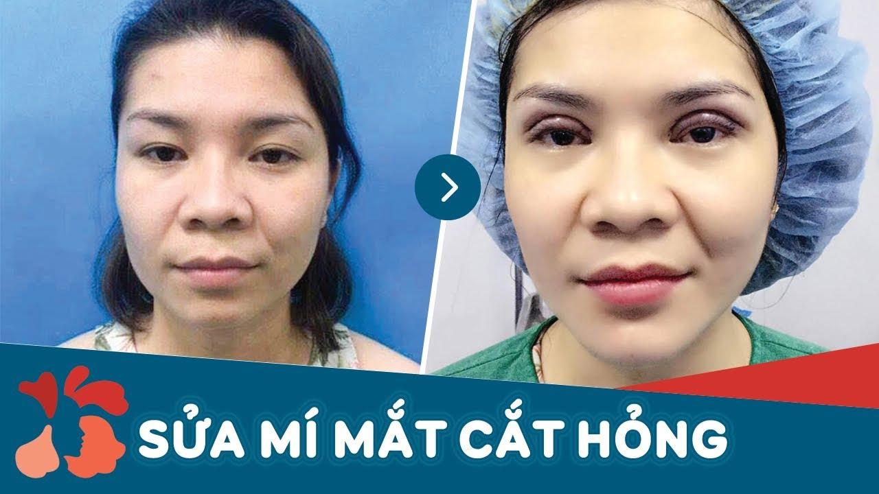 7 địa chỉ sửa mí mắt hỏng đáng tin cậy nhất tại Hà Nội - Lựa chọn hoàn hảo cho đôi mắt đẹp tự nhiên