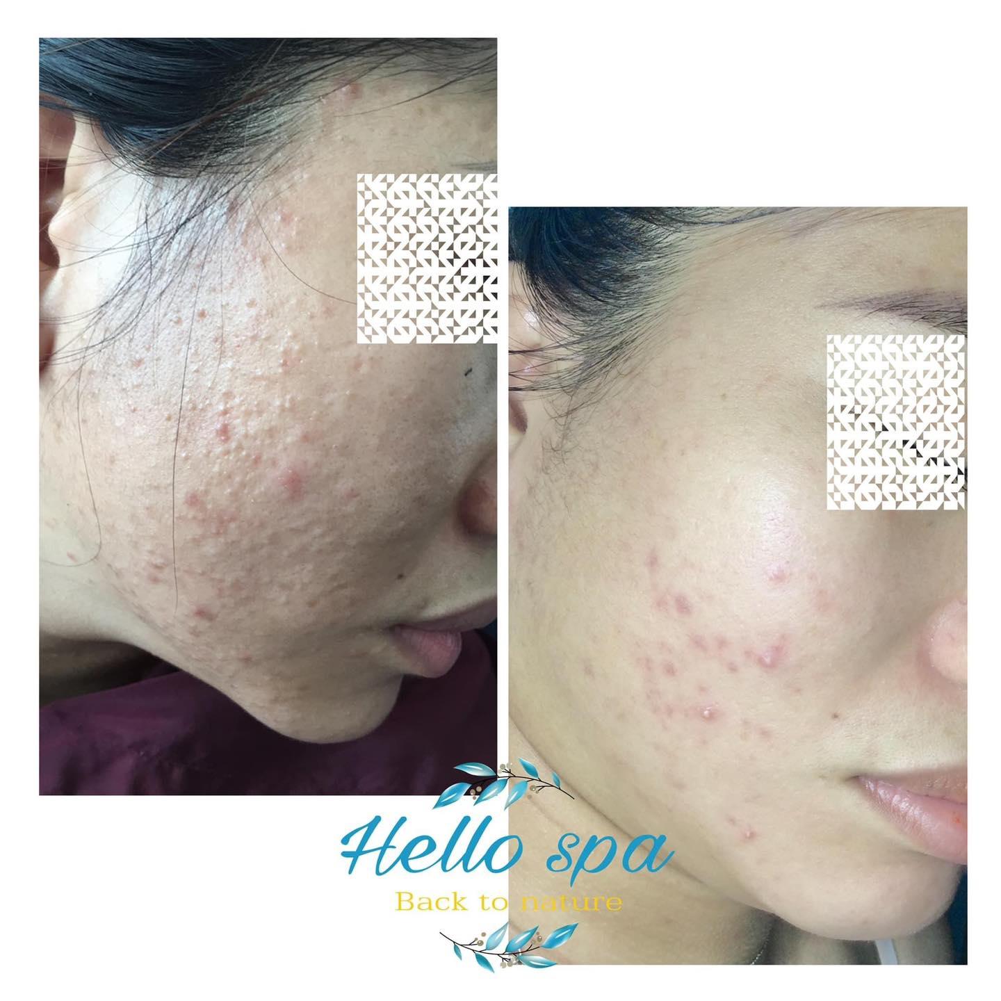 Top 9 Spa điều trị mụn hiệu quả nhất tại TP. Biên Hòa, Đồng Nai