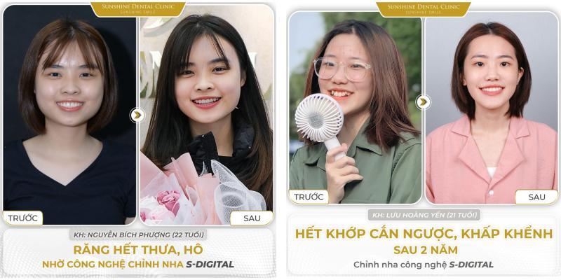 10 Địa chỉ niềng răng chất lượng và uy tín bậc nhất tại quận Hai Bà Trưng, Hà Nội
