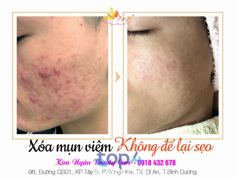 Top 5 spa trị mụn uy tín và hiệu quả nhất tại Bình Dương
