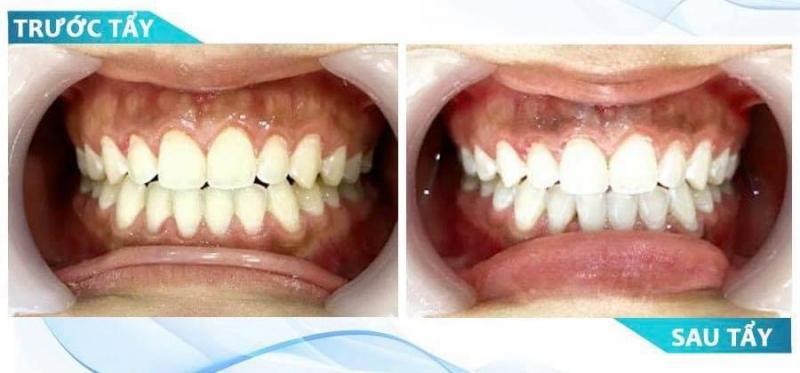 Top 10 Địa Chỉ Tẩy Trắng Răng Uy Tín Nhất Tại Tỉnh Cà Mau