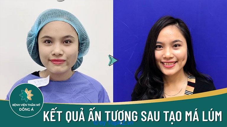 Top 10 địa chỉ thẩm mỹ tạo má lúm đồng tiền đẹp và uy tín nhất tại TPHCM